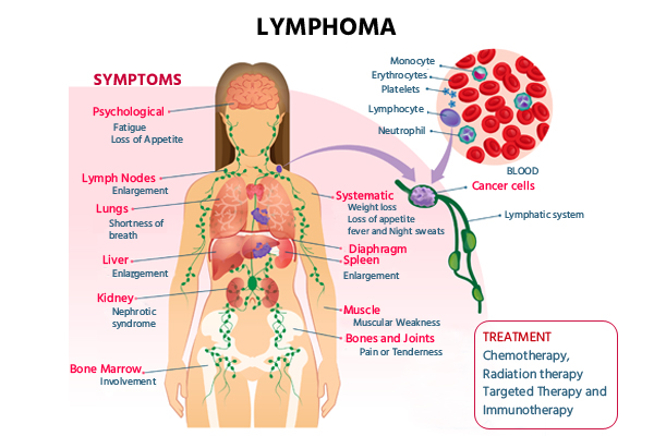 Lymphoma test