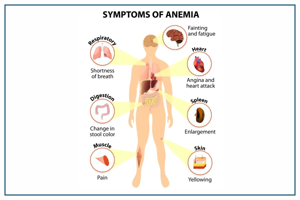 Anaemia Symptoms