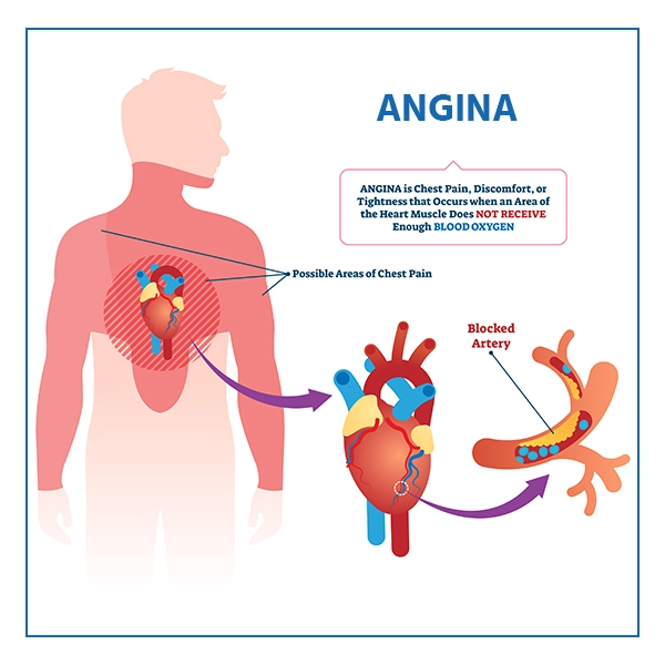 Angina Disease