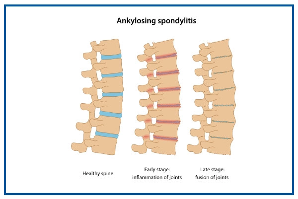 Ankylosing Spondylitis Disease