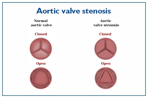 Aortic valve Stenosis overview