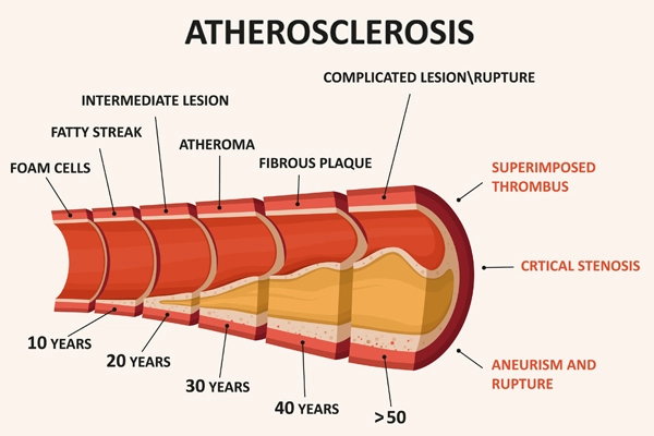 एथ्रोसक्लोरोसिस