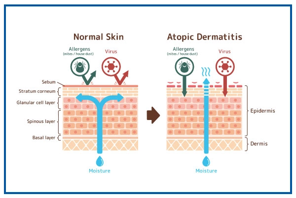 dør spejl Markeret yderligere Atopic Dermatitis: Causes & Risks, Treatment, Symptoms | Medicover