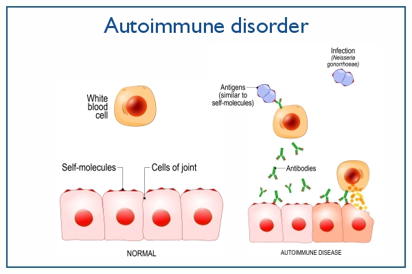 Autoimmune Disease Causes