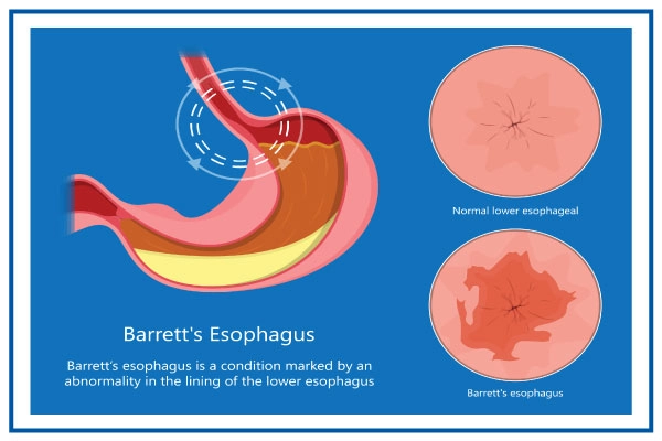 Barrett's Esophagus Overview