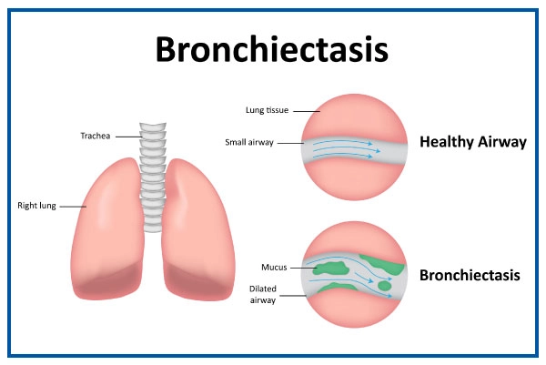 Bronchiectasis Overview