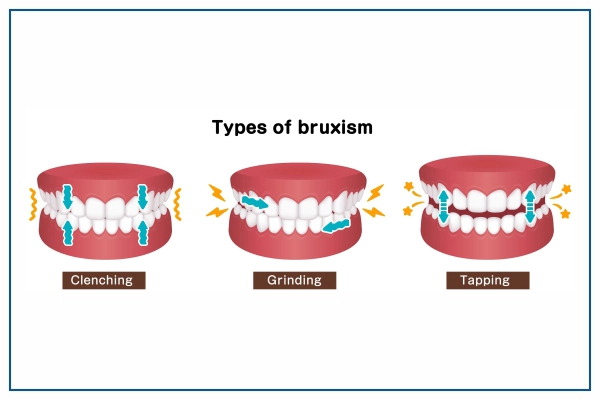 Types of Bruxism