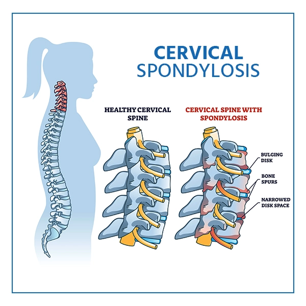cervical-spondylosis