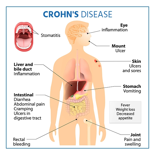 Types of Crohn's Disease