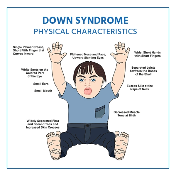 Down Syndrome Symptoms