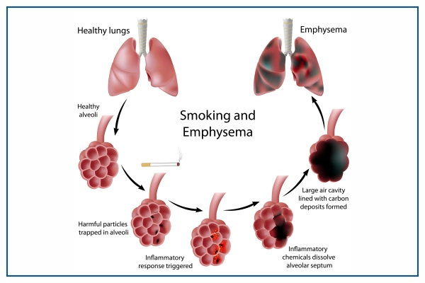 Emphysema Smoking