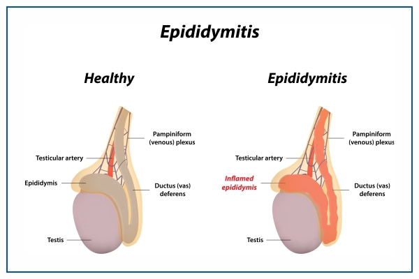 Epididymitis Overview