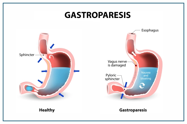 गॅस्ट्रोपेरेसिस