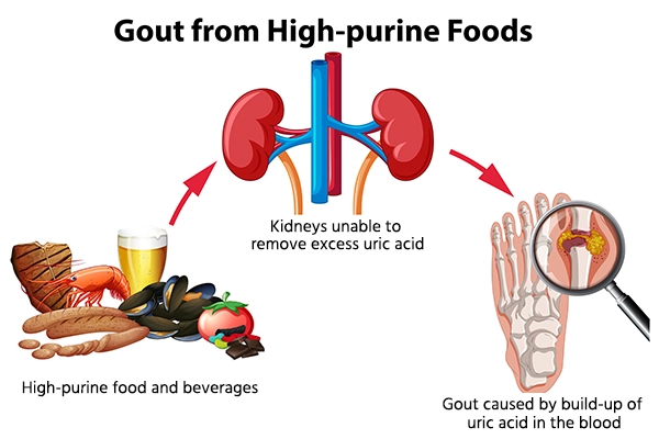 Gout Risk factors