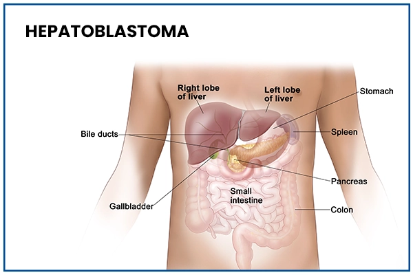 Hepatoblastoma