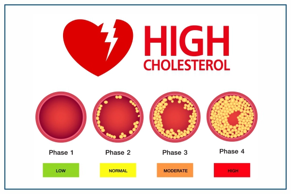 Advanced High Cholesterol treatment at Medicover