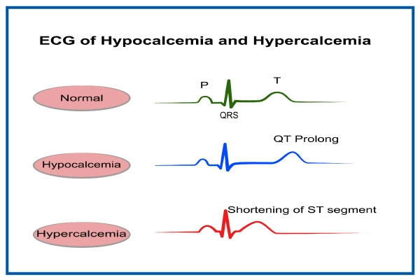 ECG of Hypercalcemia