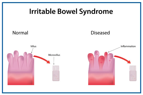 Irritable bowel syndrome overview