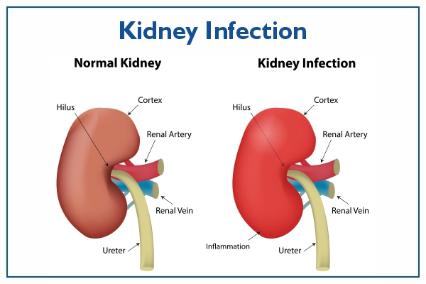 kidney infection