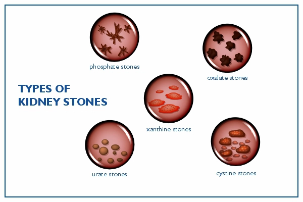 Kidney stones types