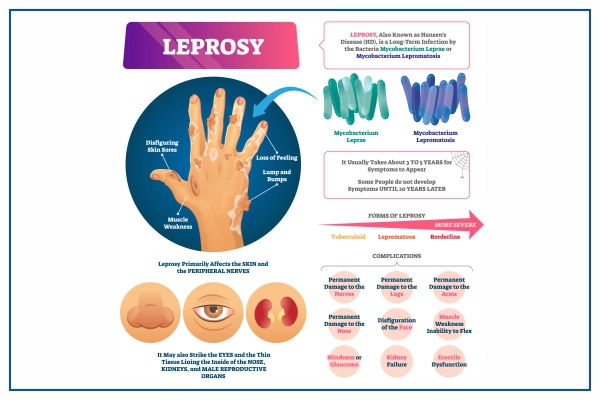 leprosy-overview