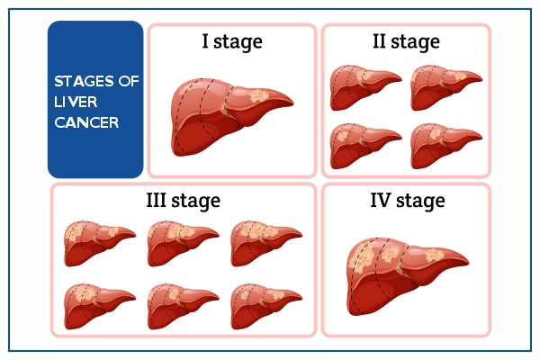 liver-cancer-stages