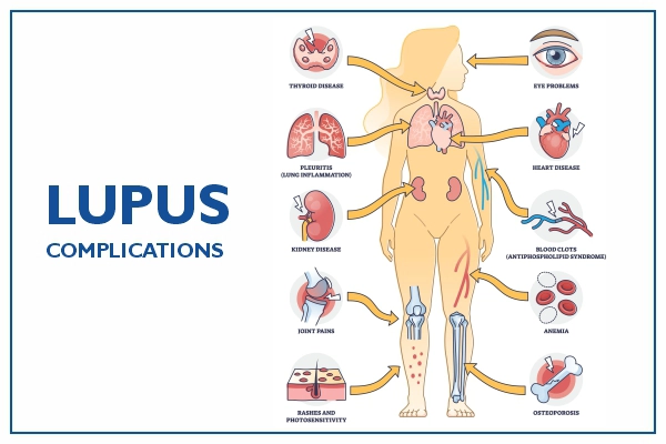 lupus complications