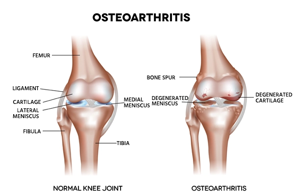 osteoarthritis overview