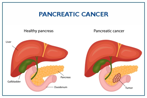 Pancreatic Cancer Overview