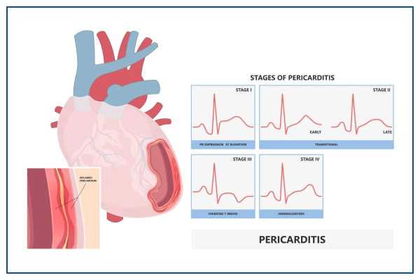Diagnosis of Pericarditis