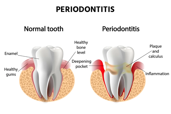 Periodontitis
