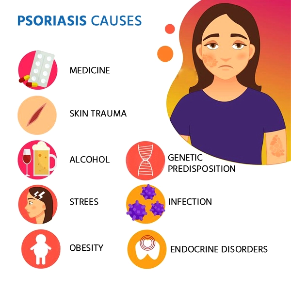 Psoriasis causes and risk factors