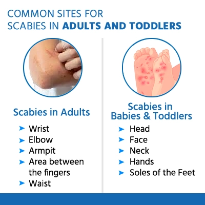 scabies-1
