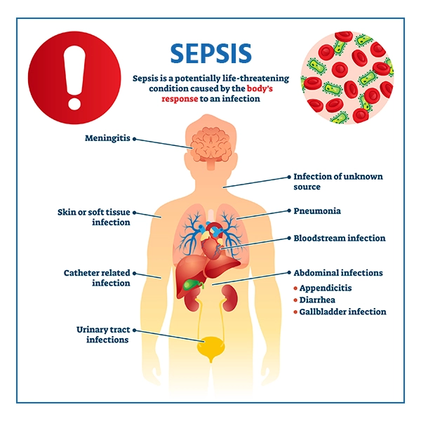 sepsis-symptoms