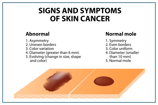 Signs and Symptoms of Skin Cancer