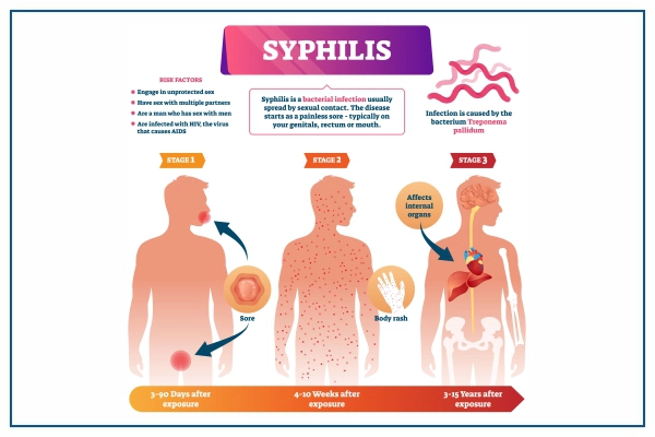 Syphilis: causes, symptômes et traitement