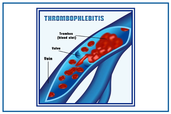 thrombophlebitis