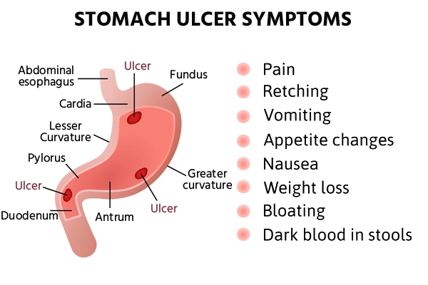 ulcer symptoms