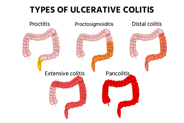 ulcerative-colitis-types