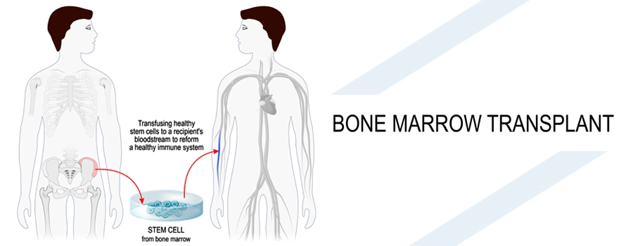 bone marrow transplant