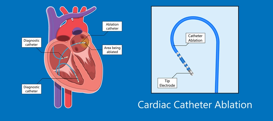 cardiac ablation