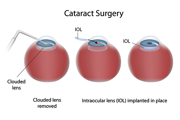 cataract surgery procedures