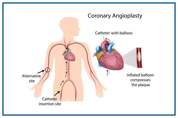 coronary angioplasty and stents insertion