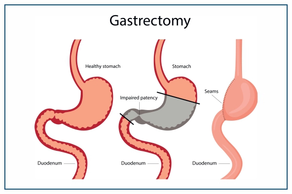 gastrectomy overview