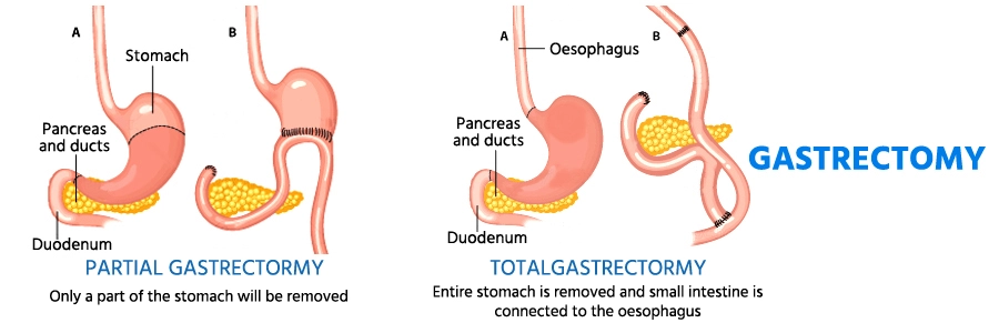 gastrectomy