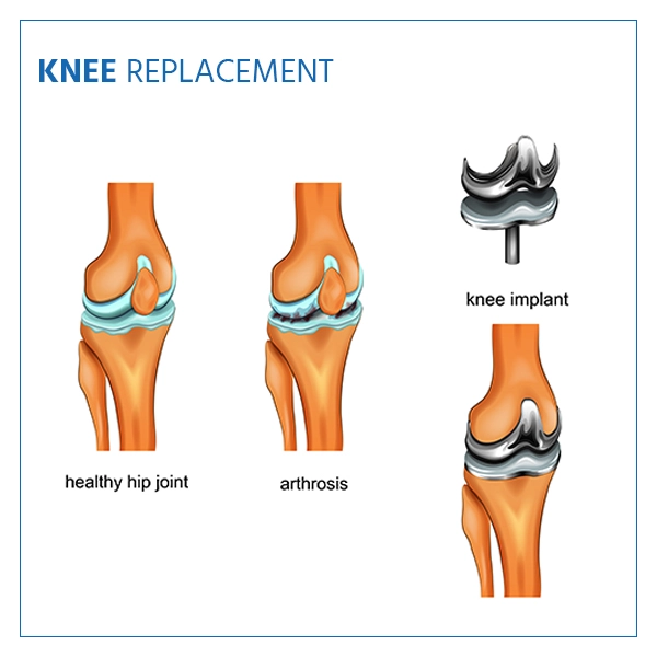 knee replacement surgery after the procedure