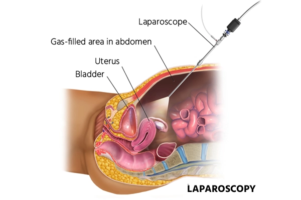Laparoscopy surgery procedure