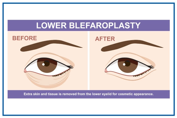 lower-blepharoplasty