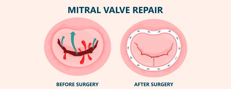 Mitral Valve replacement