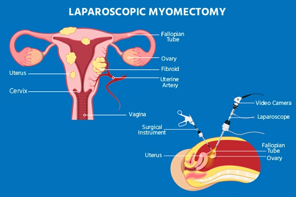 Laparascopic myomectomy